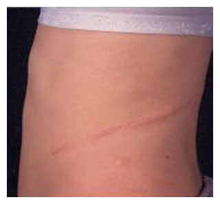 Açık Radikal Nefrektomi Ameliyatının Dezavantajları