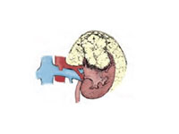 Böbrek Kanseri Evre 2