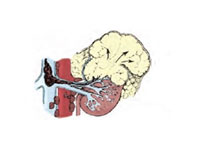 Böbrek Kanseri Evre 3