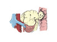 Böbrek Kanseri Evre 4