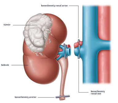 Böbrek Tümörü