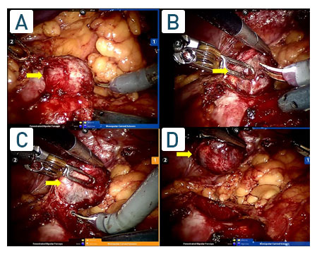 Parsiyel Nefrektomi - Böbrek Kanseri Ameliyatı