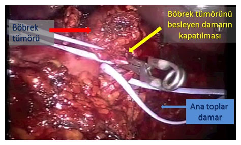 Parsiyel Nefrektomi - Böbrek Kanseri Ameliyatı