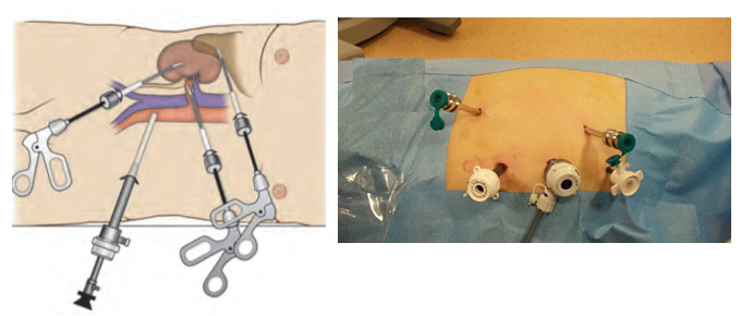 Radikal Nefrektomi - Böbrek Kanseri Ameliyatı