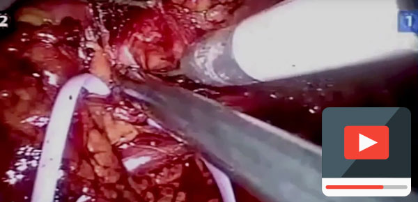 Robotik parsiyel nefrektomi ameliyatı