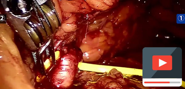  Robotik Parsiyel Nefrektomide Sıfır İskemi